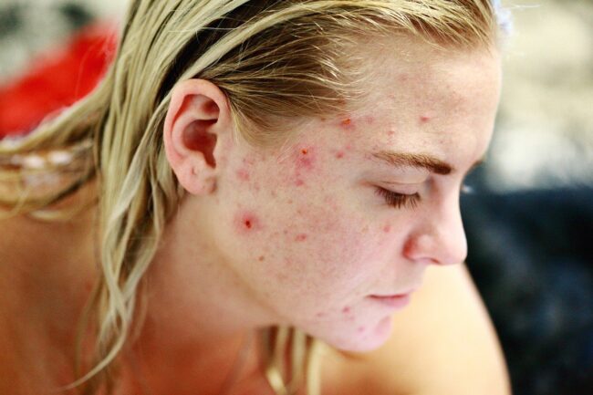 Pilule contre l’acné : les avantages et les risques